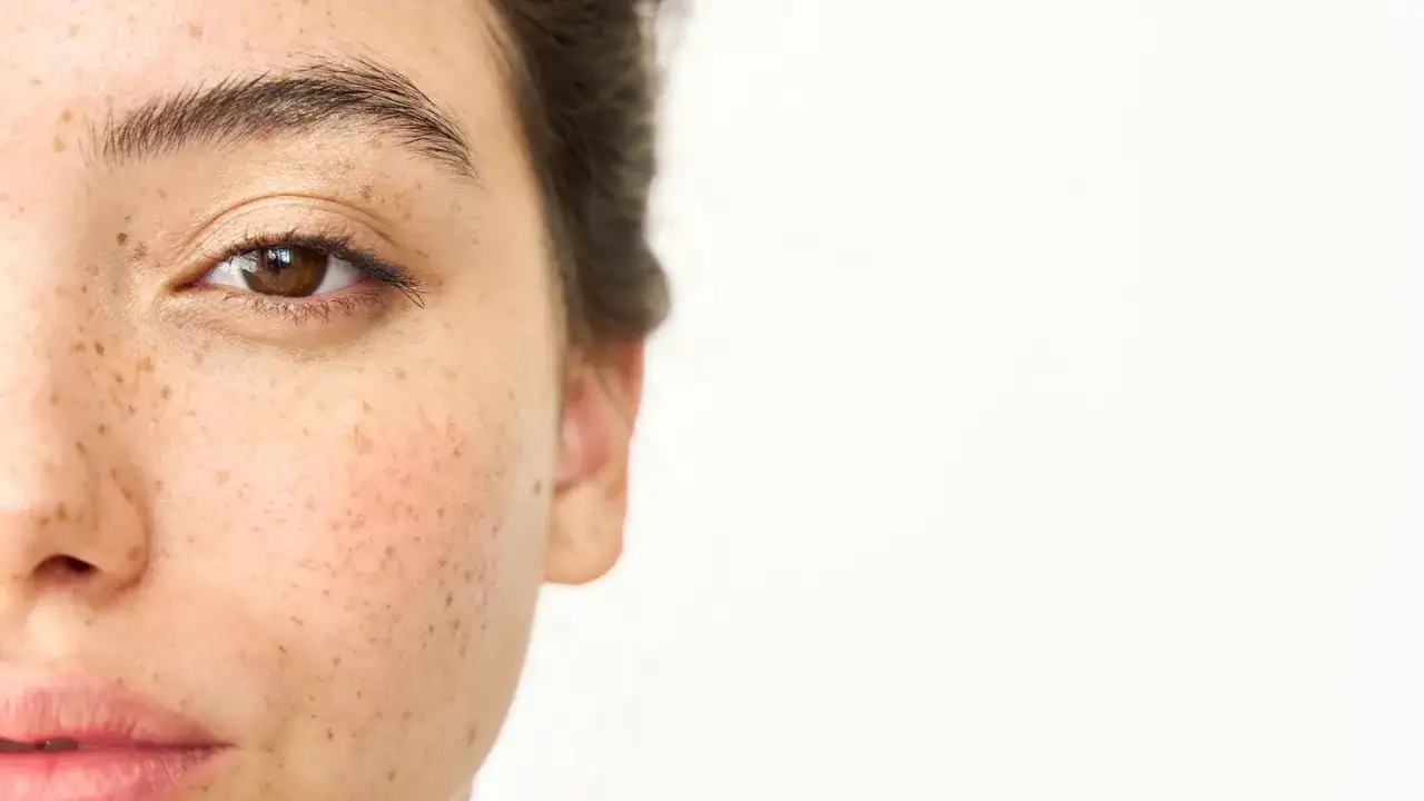 Przebarwienia twarzy - jak je rozpoznać i kiedy iść do dermatologa