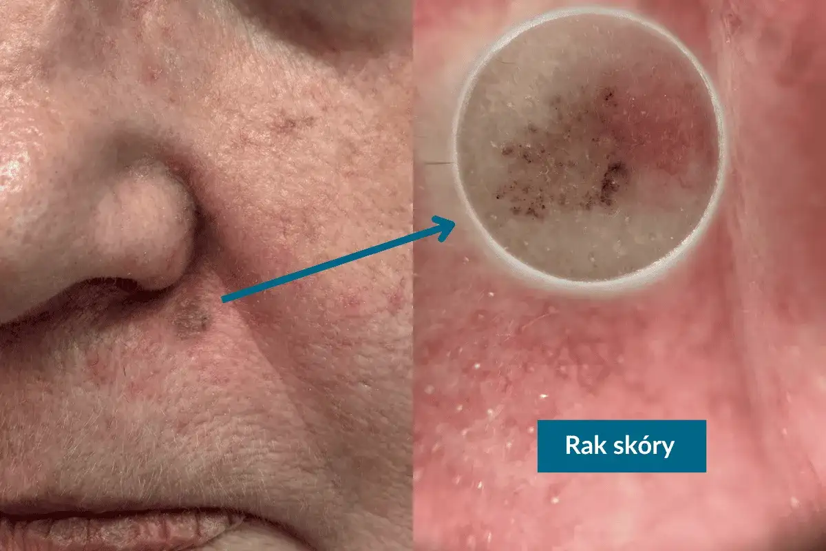 Znamiona na twarzy - kiedy są bezpieczne, a kiedy do dermatologa?